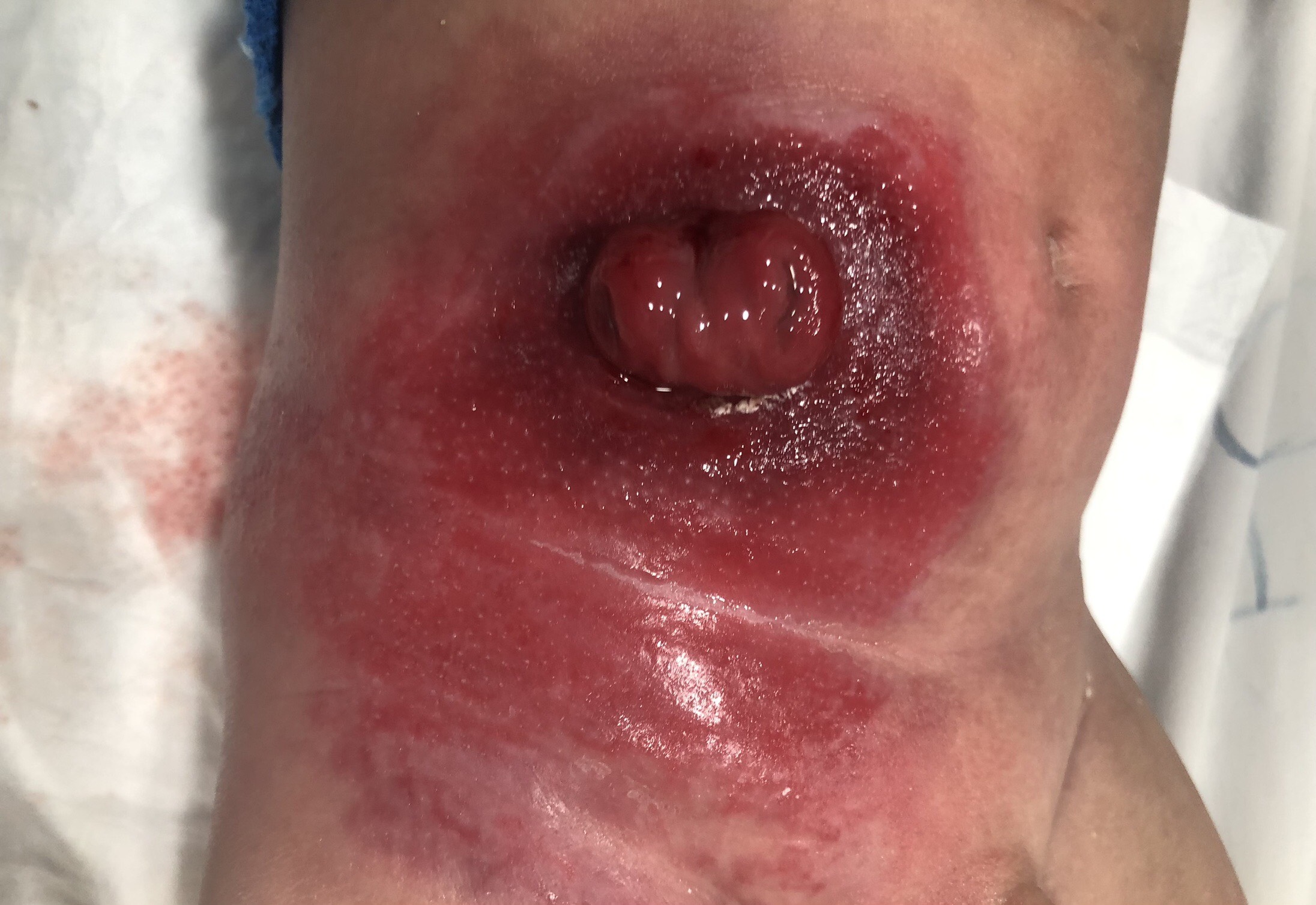 XỬ LÍ VIÊM LOÉT DA CHO BÉ 6 THÁNG TUỔI 